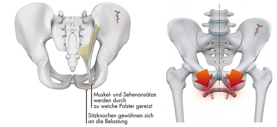 Becken-Grafik mit Schmerzpunkten und Muskel- und Sehnenansätze